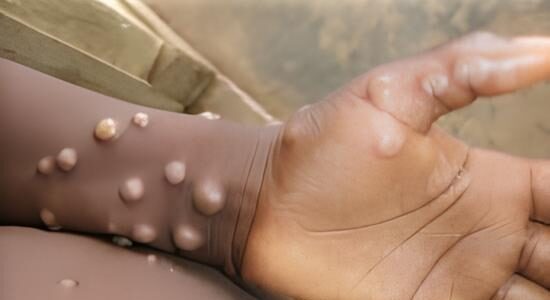 Mpox: a health threat